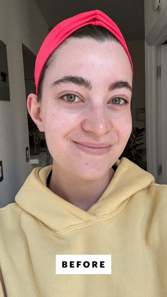 Allure senior commerce editor Sarah Felbin before applying the Mediheal Madecassoside Blemish Pads